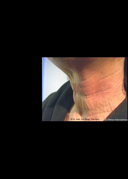 Before Image: Pellevé® Patient 13 - other
