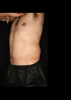 After Image: Smartlipo™ Patient 1 - left-front-oblique