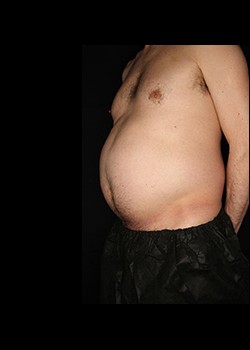 Before Image: Smartlipo™ Patient 1 - left-front-oblique