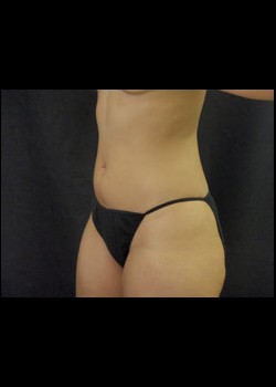 Before Image: Smartlipo™ Patient 2 - left-front-oblique