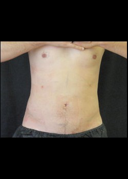 After Image: Smartlipo™ Patient 3 - front