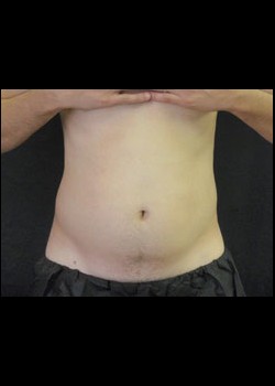 Before Image: Smartlipo™ Patient 3 - front