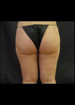 After Image: Smartlipo™ Patient 4 - back