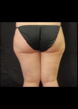 Before Image: Smartlipo™ Patient 4 - back