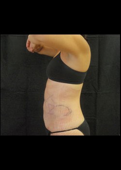 After Image: Smartlipo™ Patient 5 - other