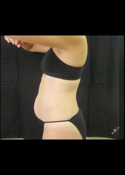 Before Image: Smartlipo™ Patient 5 - other