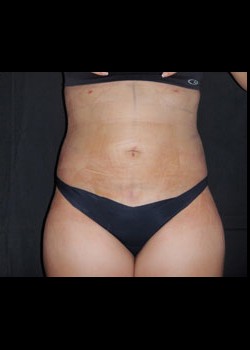 After Image: Smartlipo™ Patient 6 - front