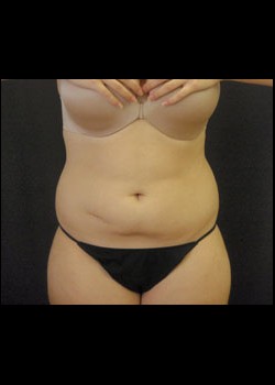 Before Image: Smartlipo™ Patient 6 - front