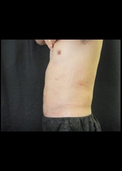 After Image: Smartlipo™ Patient 7 - other