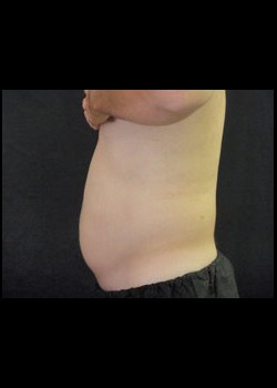 Before Image: Smartlipo™ Patient 7 - other