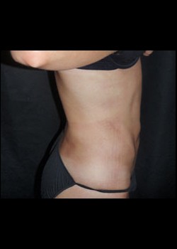 After Image: Smartlipo™ Patient 8 - other