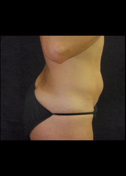 Before Image: Smartlipo™ Patient 8 - other
