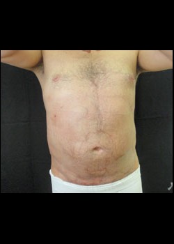 Smartlipo™ Patient 9