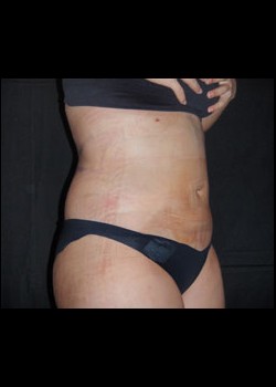 After Image: Smartlipo™ Patient 10 - right-front-oblique