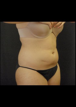 Before Image: Smartlipo™ Patient 10 - right-front-oblique