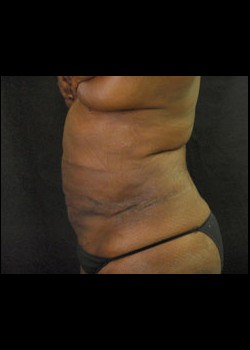 After Image: Smartlipo™ Patient 11 - other