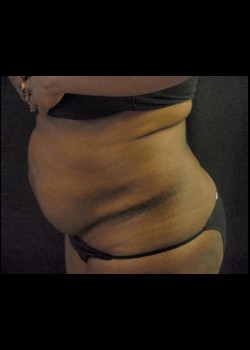 Before Image: Smartlipo™ Patient 11 - other