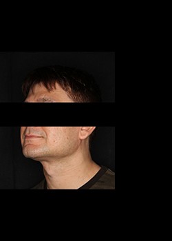 After Image: Smartlipo™ Patient 12 - left-front-oblique