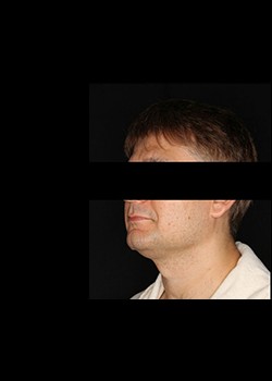 Before Image: Smartlipo™ Patient 12 - left-front-oblique