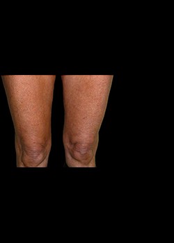 After Image: Thermage® Patient 1 - front