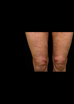 Before Image: Thermage® Patient 1 - front