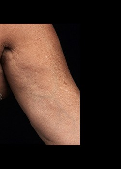 After Image: Thermage® Patient 2 - other