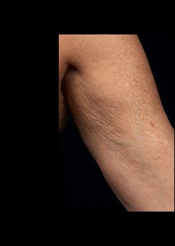 Before Image: Thermage® Patient 2 - other