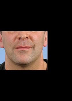 After Image: Thermage® Patient 3 - front