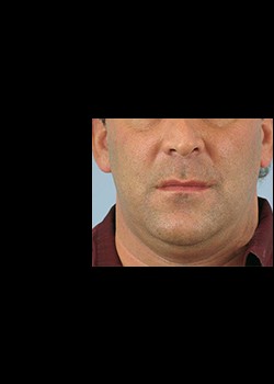 Before Image: Thermage® Patient 3 - front