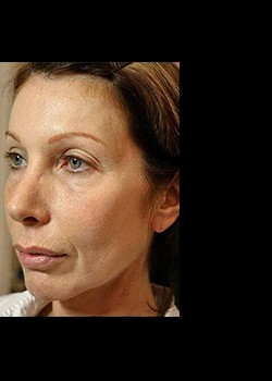 After Image: Thermage® Patient 4 - left-front-oblique