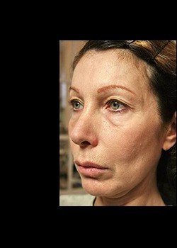 Before Image: Thermage® Patient 4 - left-front-oblique
