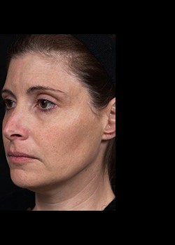 After Image: Thermage® Patient 5 - left-front-oblique