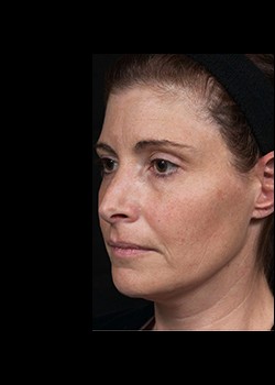 Before Image: Thermage® Patient 5 - left-front-oblique