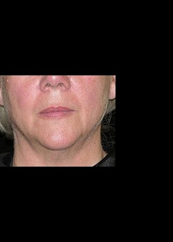 After Image: Thermage® Patient 6 - front