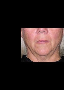 Before Image: Thermage® Patient 6 - front