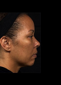 After Image: Thermage® Patient 8 - other