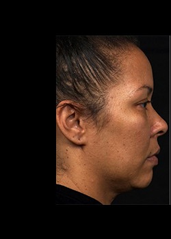 Before Image: Thermage® Patient 8 - other