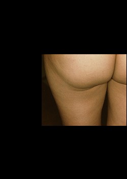 Before Image: Thermage® Patient 9 - other