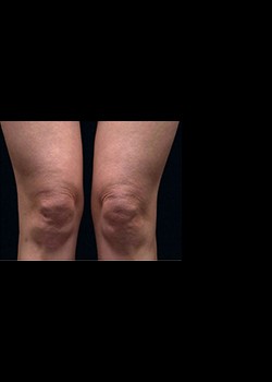 After Image: Thermage® Patient 10 - front