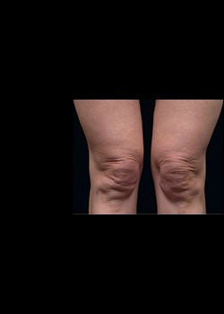 Before Image: Thermage® Patient 10 - front