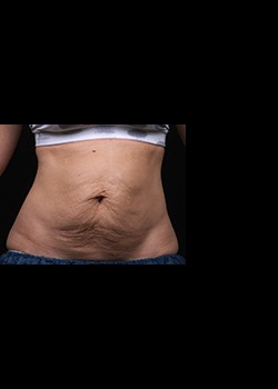 After Image: Thermage® Patient 11 - front