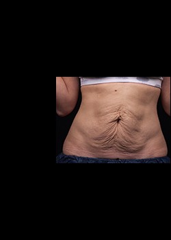 Before Image: Thermage® Patient 11 - front