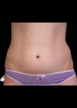 Before Image: Emsculpt® Patient 1 - front