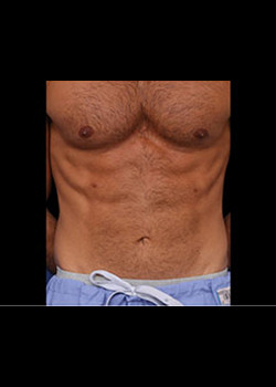 After Image: Emsculpt® Patient 2 - front