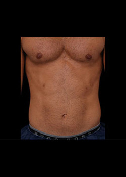 Before Image: Emsculpt® Patient 2 - front