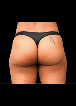 After Image: Emsculpt® Patient 3 - front