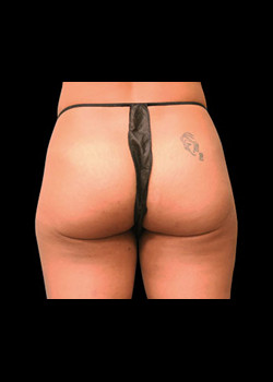 Before Image: Emsculpt® Patient 3 - front